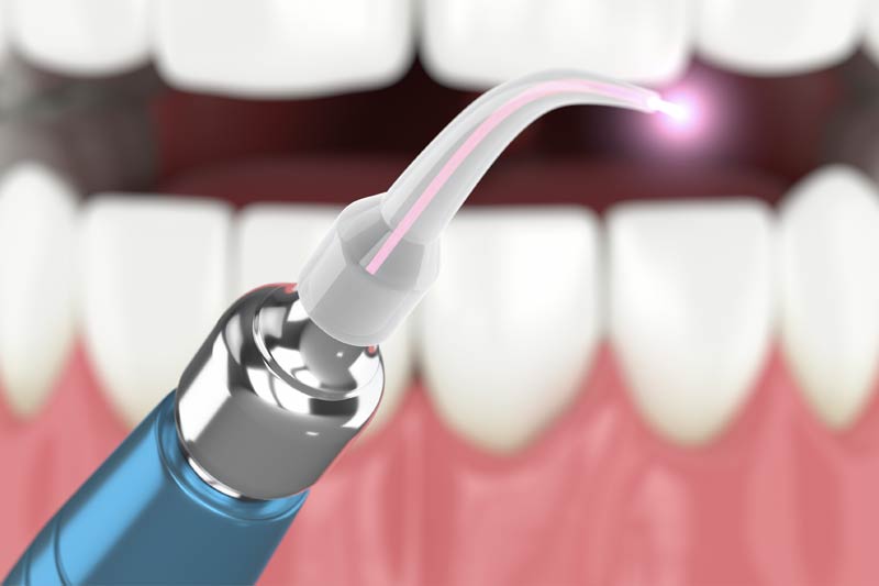 Laser Dentistry in Fishers