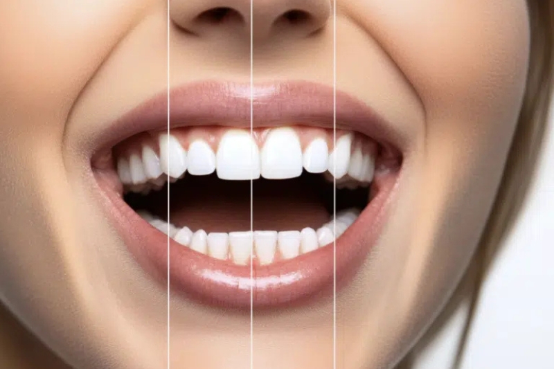 Quality Dental Treatments in Fishers