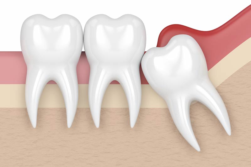 Wisdom Tooth Removal in Fishers